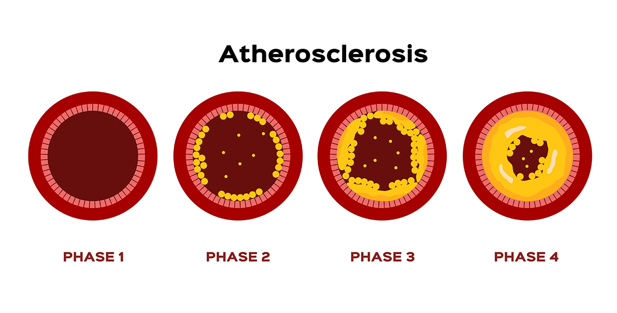 aterosclerosi-BOX2-ok-